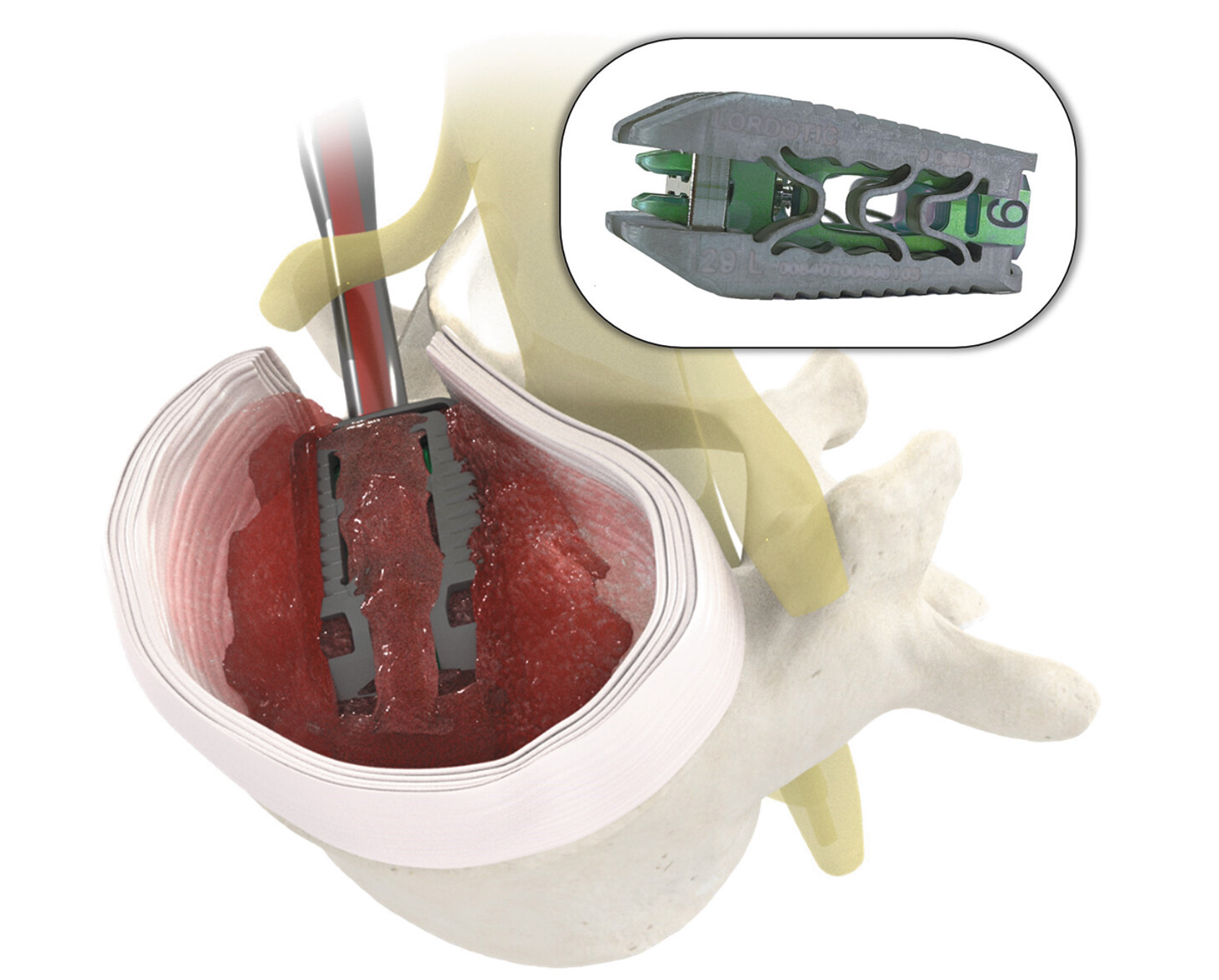 Understanding Endoscopic Spine Fusion
