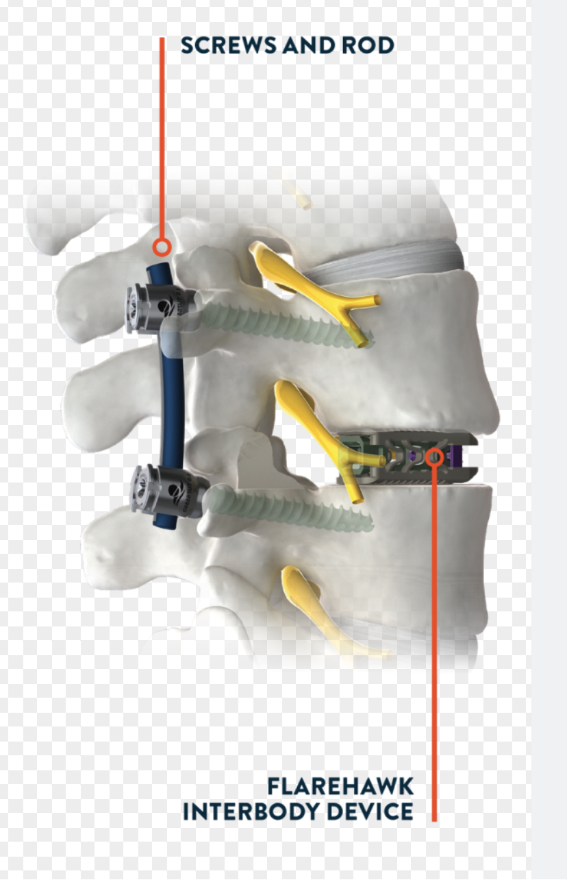 Advantages of Endoscopic Spine Fusion