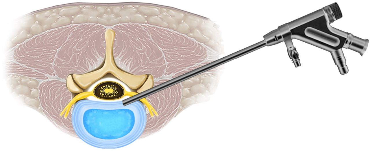 Transforaminal Endoscopic Surgery