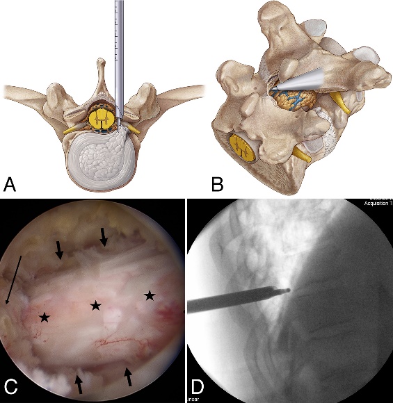 Interlaminar Endoscopic Procedure